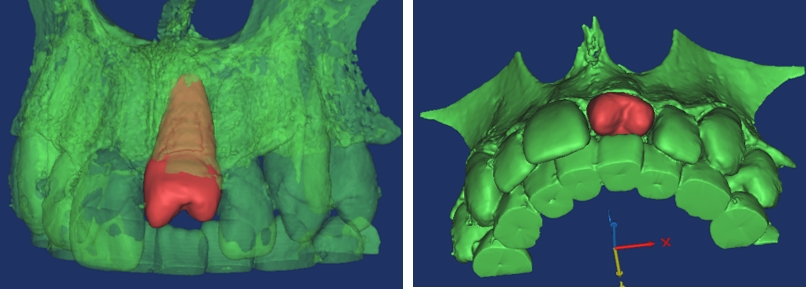 Tooth Autotransplantation